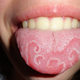 Illustration for article titled Do You Have A Geographic Tongue?